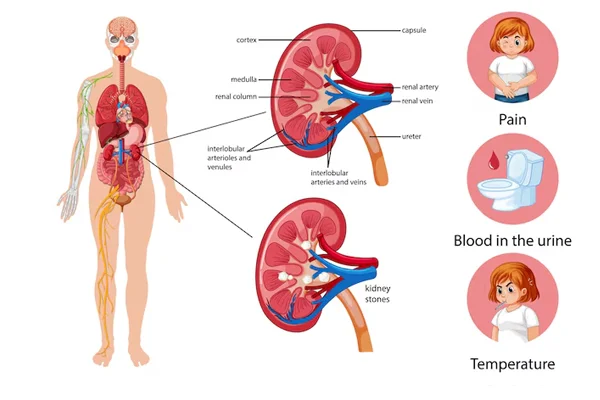 Glomerulonephritis  Autoimmune Kidney Diseases