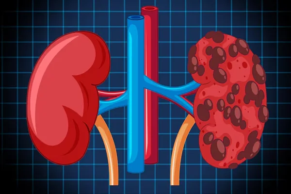 Diabetic Nephropathy and Hypertensive Kidney Disease